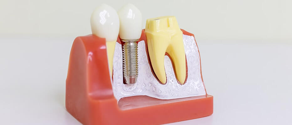 Dental Implants