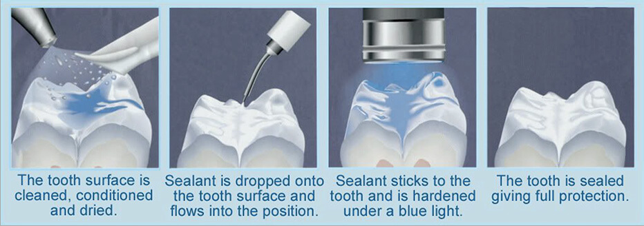 Dental Sealant