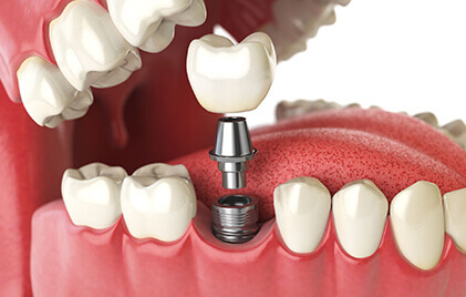 Dental Implants